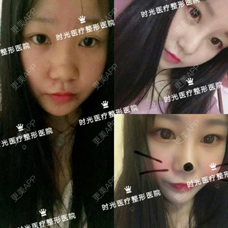 更美 - 南昌时光医疗美容门诊部的隆鼻经验 | 南昌 | 视频日记 | 隆鼻