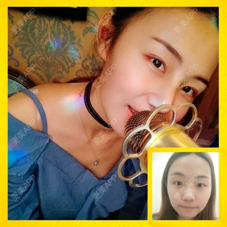 更美 - 南昌时光医疗美容门诊部的隆鼻经验 | 南昌 | 视频日记 | 隆鼻