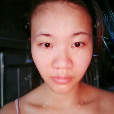 鼻翼缩小
