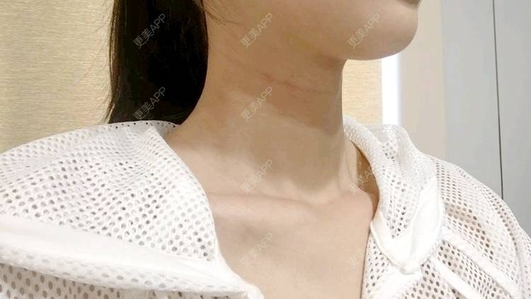 更美 - Annie嵉的自体脂肪填充颈纹经验 | 上海 | 自体脂肪填充颈纹