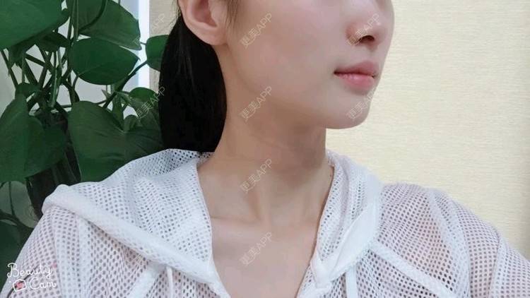 更美 - Annie嵉的自体脂肪填充颈纹经验 | 上海 | 自体脂肪填充颈纹