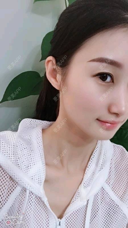 更美 - Annie嵉的自体脂肪填充颈纹经验 | 上海 | 自体脂肪填充颈纹