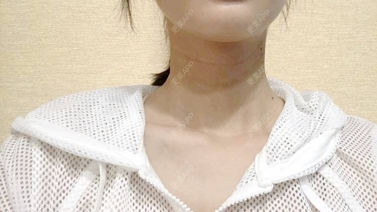 更美 - Annie嵉的自体脂肪填充颈纹经验 | 上海 | 自体脂肪填充颈纹