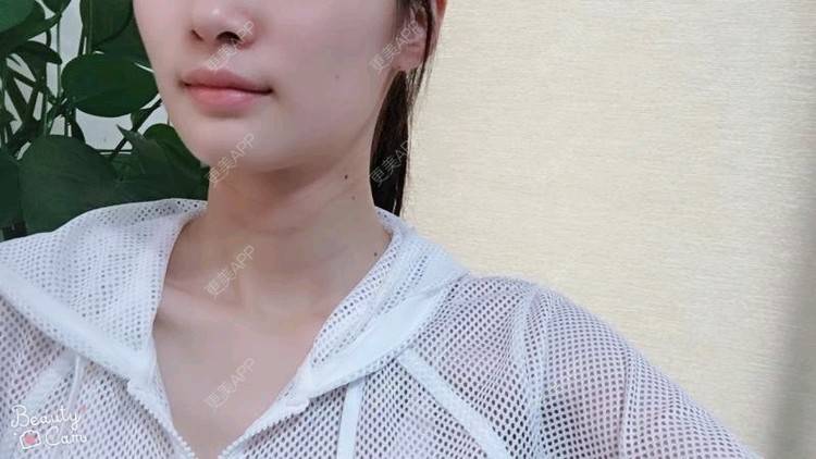 更美 - Annie嵉的自体脂肪填充颈纹经验 | 上海 | 自体脂肪填充颈纹