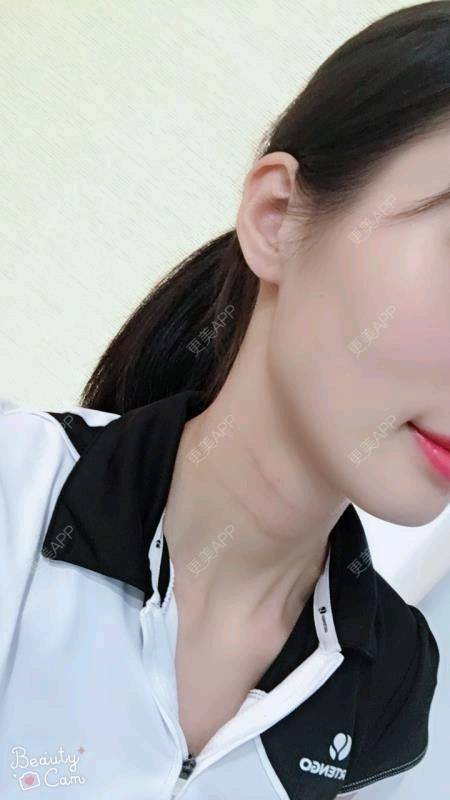 更美 - Annie嵉的自体脂肪填充颈纹经验 | 上海 | 自体脂肪填充颈纹