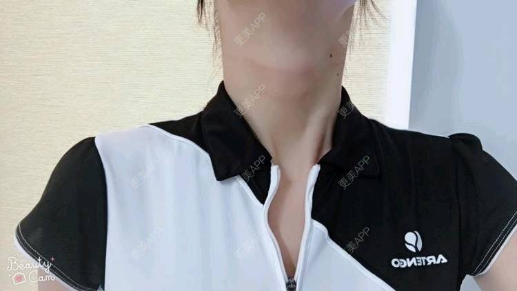 更美 - Annie嵉的自体脂肪填充颈纹经验 | 上海 | 自体脂肪填充颈纹