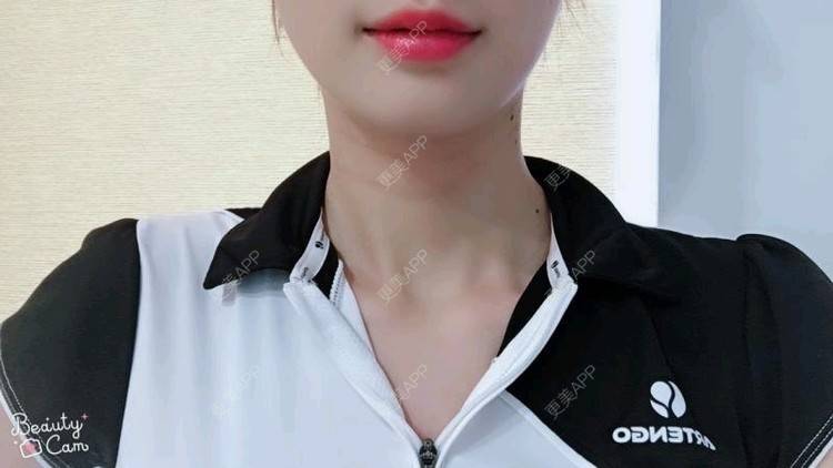 更美 - Annie嵉的自体脂肪填充颈纹经验 | 上海 | 自体脂肪填充颈纹