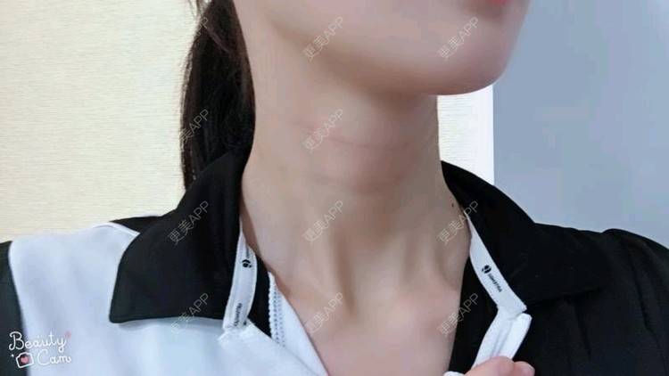 更美 - Annie嵉的自体脂肪填充颈纹经验 | 上海 | 自体脂肪填充颈纹