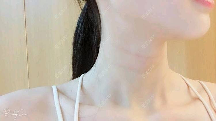 更美 - Annie嵉的自体脂肪填充颈纹经验 | 上海 | 自体脂肪填充颈纹