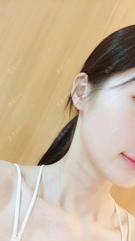 更美 - Annie嵉的自体脂肪填充颈纹经验 | 上海 | 自体脂肪填充颈纹