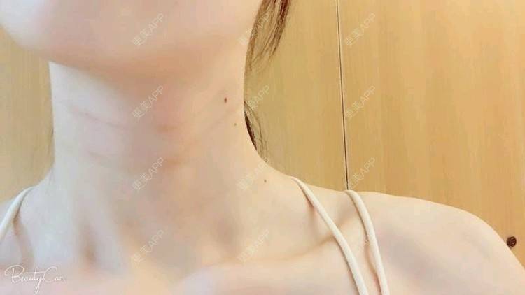 更美 - Annie嵉的自体脂肪填充颈纹经验 | 上海 | 自体脂肪填充颈纹