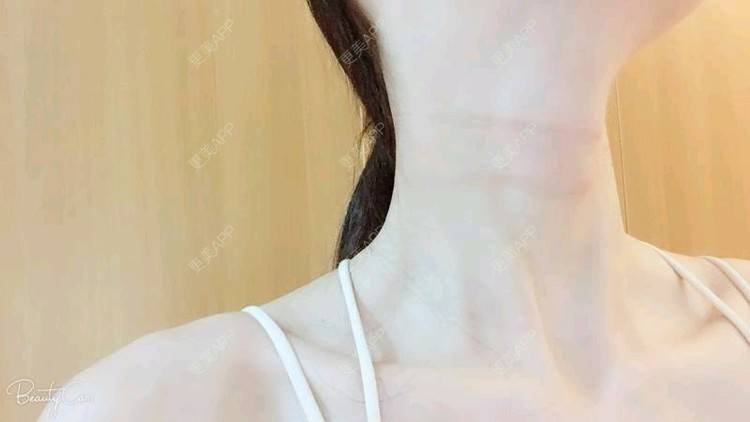 更美 - Annie嵉的自体脂肪填充颈纹经验 | 上海 | 自体脂肪填充颈纹