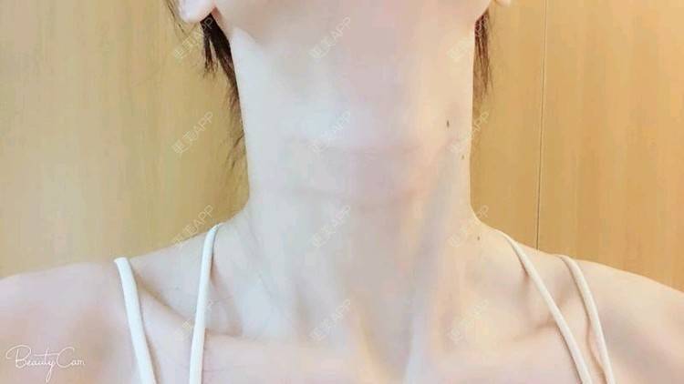 更美 - Annie嵉的自体脂肪填充颈纹经验 | 上海 | 自体脂肪填充颈纹