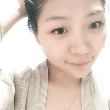自体脂肪丰额头