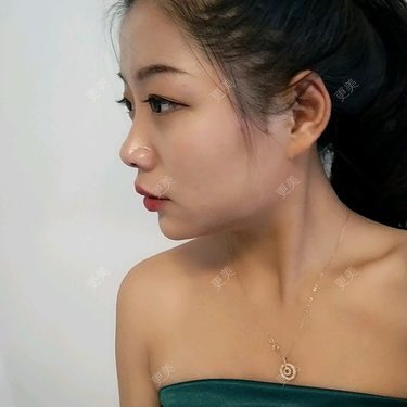 自体脂肪丰额头