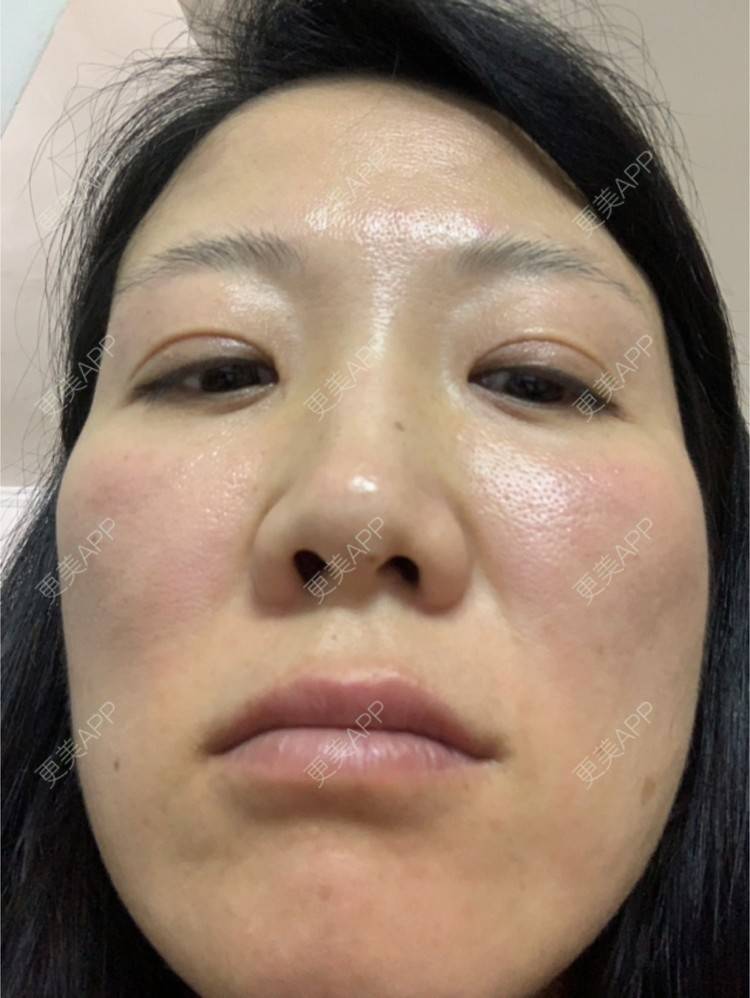 更美 - 舒怡的经验 | 自体脂肪隆胸 | 自体脂肪丰太阳穴 | 硅胶隆鼻 | 水光项目 | 牙齿矫正 | 双眼皮 | 上海 | 北京 | 除皱瘦脸 | 武汉 | 埋线提升 | 长沙 | 广州 | 牙贴面 | 深圳 | 南昌 | 南京 | 鼻部综合