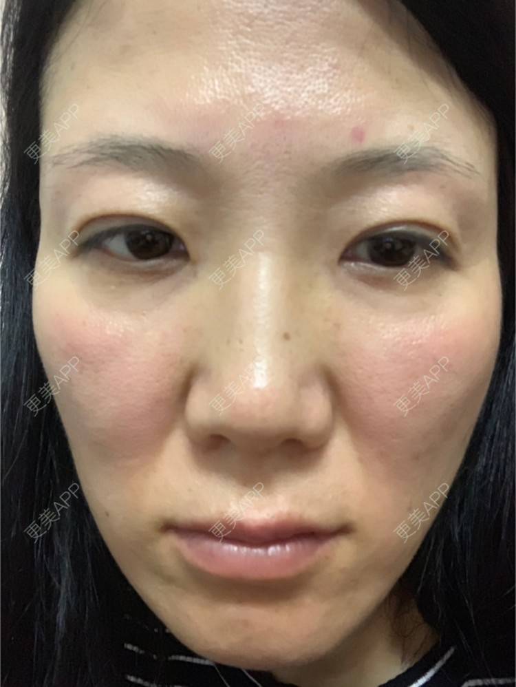 更美 - 舒怡的经验 | 自体脂肪隆胸 | 自体脂肪丰太阳穴 | 硅胶隆鼻 | 水光项目 | 牙齿矫正 | 双眼皮 | 上海 | 北京 | 除皱瘦脸 | 武汉 | 埋线提升 | 长沙 | 广州 | 牙贴面 | 深圳 | 南昌 | 南京 | 鼻部综合