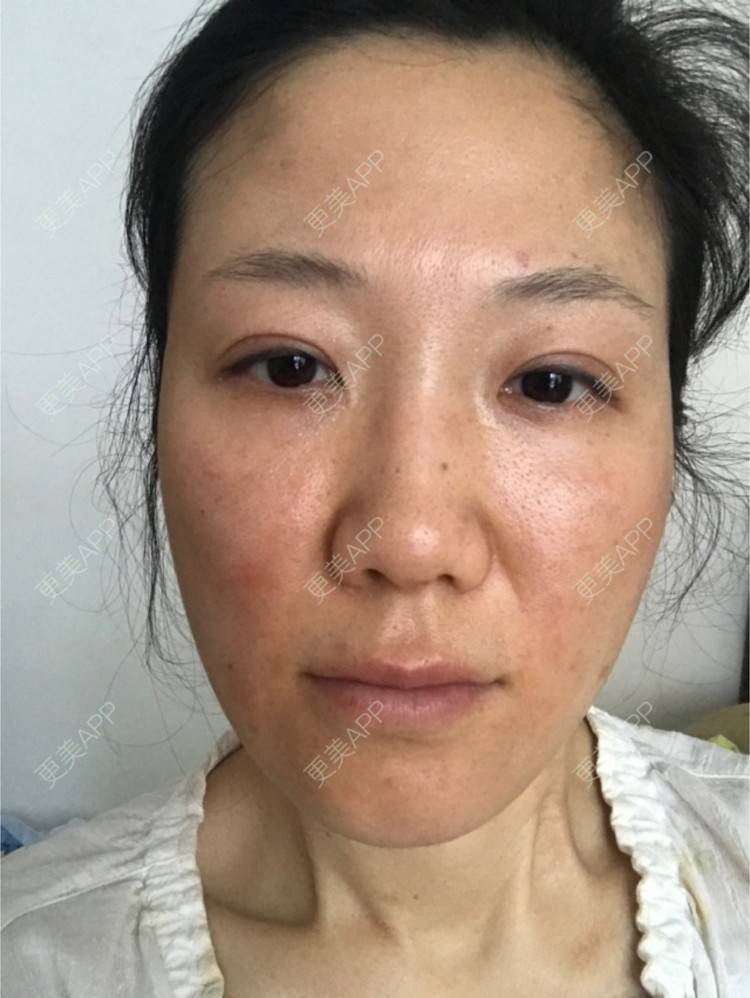 更美 - 舒怡的经验 | 自体脂肪隆胸 | 自体脂肪丰太阳穴 | 硅胶隆鼻 | 水光项目 | 牙齿矫正 | 双眼皮 | 上海 | 北京 | 除皱瘦脸 | 武汉 | 埋线提升 | 长沙 | 广州 | 牙贴面 | 深圳 | 南昌 | 南京 | 鼻部综合