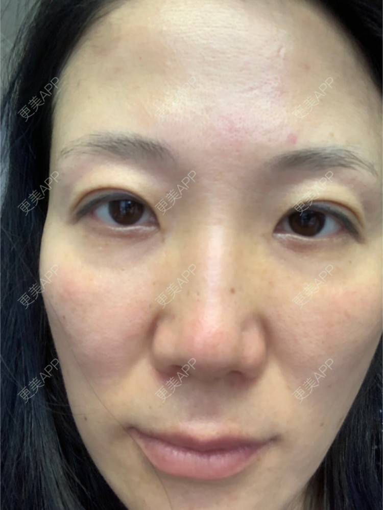 更美 - 舒怡的经验 | 自体脂肪隆胸 | 自体脂肪丰太阳穴 | 硅胶隆鼻 | 水光项目 | 牙齿矫正 | 双眼皮 | 上海 | 北京 | 除皱瘦脸 | 武汉 | 埋线提升 | 长沙 | 广州 | 牙贴面 | 深圳 | 南昌 | 南京 | 鼻部综合