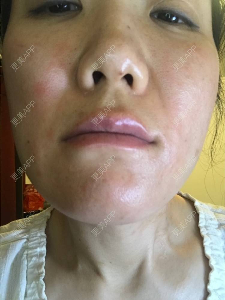 更美 - 舒怡的经验 | 自体脂肪隆胸 | 自体脂肪丰太阳穴 | 硅胶隆鼻 | 水光项目 | 牙齿矫正 | 双眼皮 | 上海 | 北京 | 除皱瘦脸 | 武汉 | 埋线提升 | 长沙 | 广州 | 牙贴面 | 深圳 | 南昌 | 南京 | 鼻部综合