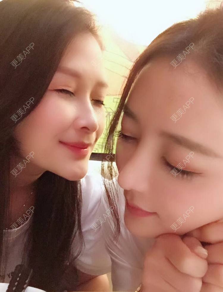 更美 - 莹莹D緈諨的鼻部多项经验 | 视频日记 | 鼻部多项 | 膨体隆鼻 | 广州 | 肋软骨隆鼻 | 驼峰鼻矫正 | 鼻形态修复