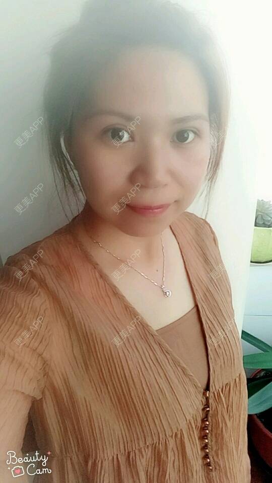 更美 - 不语却知心。的人中缩短经验 | 人中缩短 | 杭州 | 水光项目 | 双眼皮 | 白瓷娃娃 | 蚌埠 | 广州 | 深圳 | 牙贴面 | 南京 | 全切双眼皮