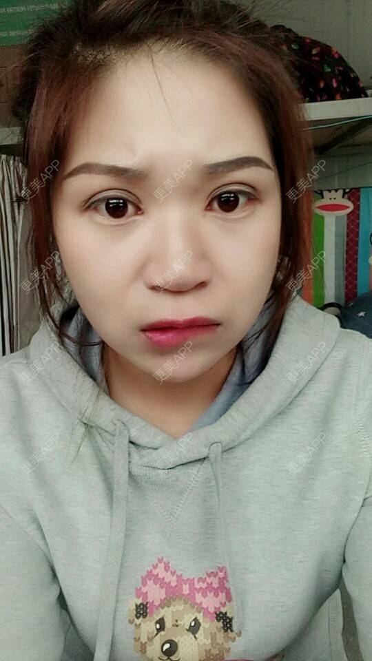 更美 - 不语却知心。的人中缩短经验 | 人中缩短 | 杭州 | 水光项目 | 双眼皮 | 白瓷娃娃 | 蚌埠 | 广州 | 深圳 | 牙贴面 | 南京 | 全切双眼皮
