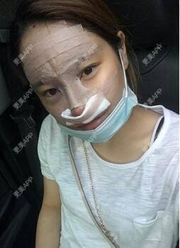 更美 - 苍卉的自体脂肪隆鼻经验 | 自体脂肪隆鼻 | 西安