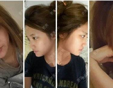 更美 - 苍卉的自体脂肪隆鼻经验 | 自体脂肪隆鼻 | 西安