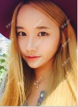 更美 - 苍卉的自体脂肪隆鼻经验 | 自体脂肪隆鼻 | 西安