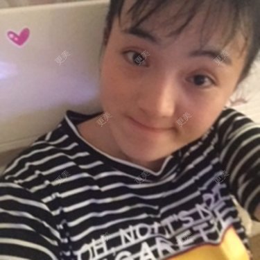 自体脂肪全面部填充