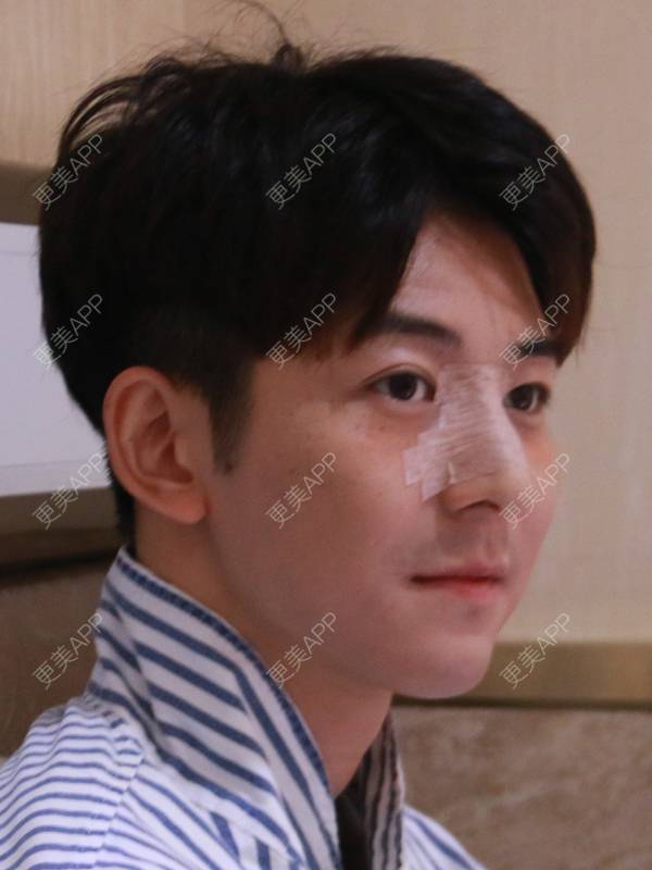 更美 - 唐航 医生的隆鼻经验 | 隆鼻 | 深圳