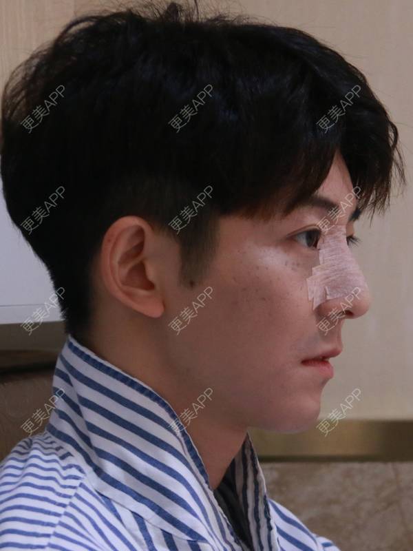 更美 - 唐航 医生的隆鼻经验 | 隆鼻 | 深圳