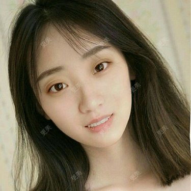 鼻翼缩小