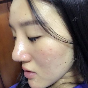 鼻部多项