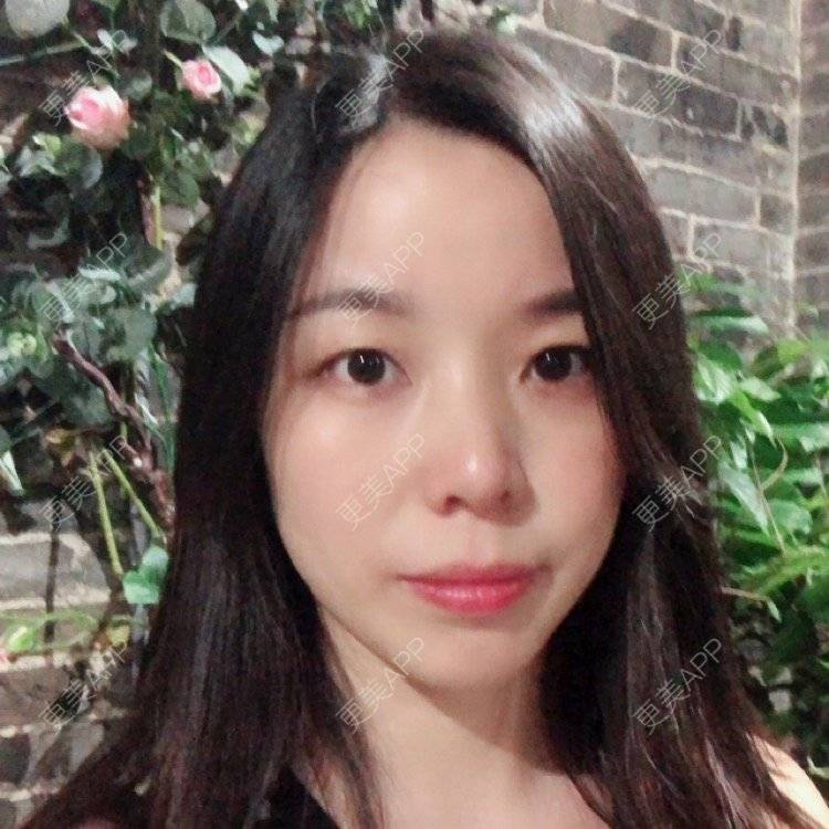 更美 - 彩儿er的激光淡斑经验 | 激光淡斑 | 成都
