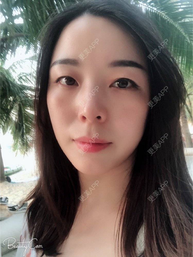 更美 - 彩儿er的激光淡斑经验 | 激光淡斑 | 成都