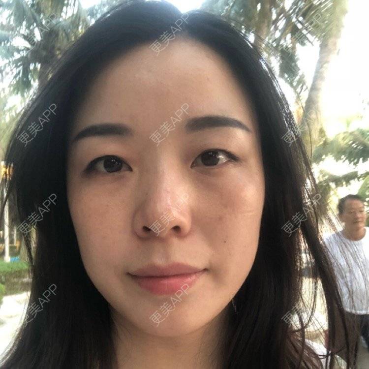 更美 - 彩儿er的激光淡斑经验 | 激光淡斑 | 成都