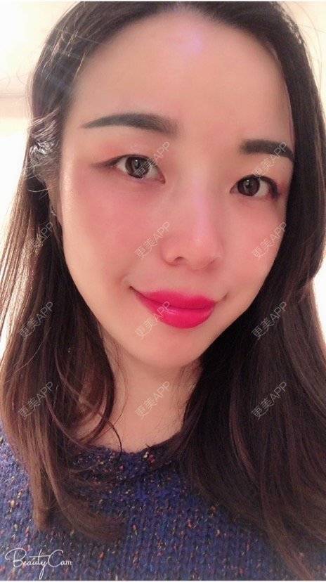 更美 - 彩儿er的激光淡斑经验 | 激光淡斑 | 成都