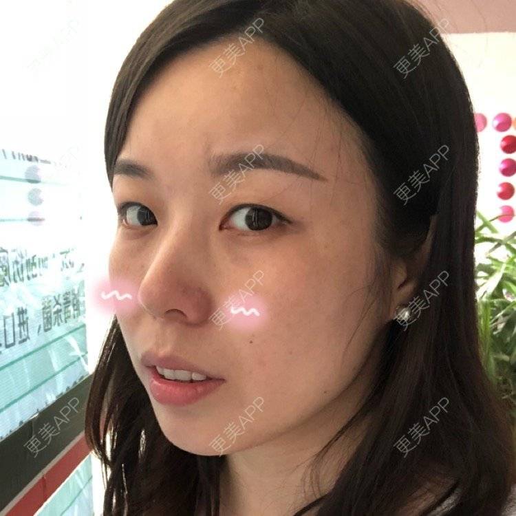 更美 - 彩儿er的激光淡斑经验 | 激光淡斑 | 成都