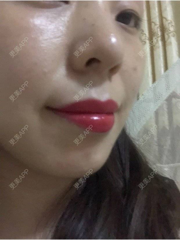 更美 - 彩儿er的激光淡斑经验 | 激光淡斑 | 成都