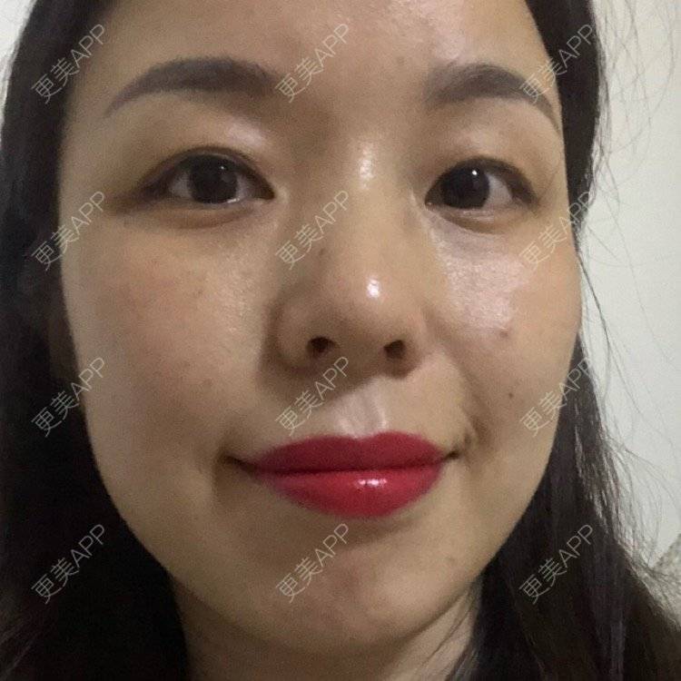 更美 - 彩儿er的激光淡斑经验 | 激光淡斑 | 成都