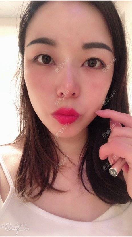 更美 - 彩儿er的激光淡斑经验 | 激光淡斑 | 成都