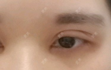 双眼皮修复