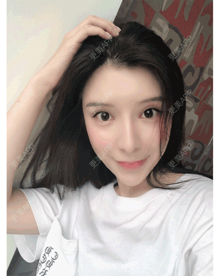 更美 - 罗莉 医生的鼻部多项经验 | 福州 | 隆鼻 | 鼻部多项 | 鼻部综合