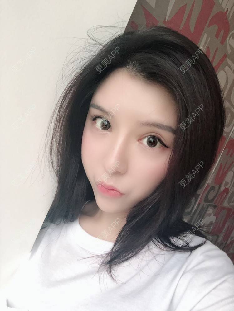 更美 - 罗莉 医生的鼻部多项经验 | 福州 | 隆鼻 | 鼻部多项 | 鼻部综合
