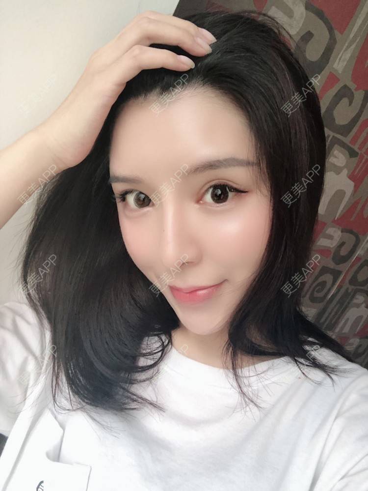 更美 - 罗莉 医生的鼻部多项经验 | 福州 | 隆鼻 | 鼻部多项 | 鼻部综合