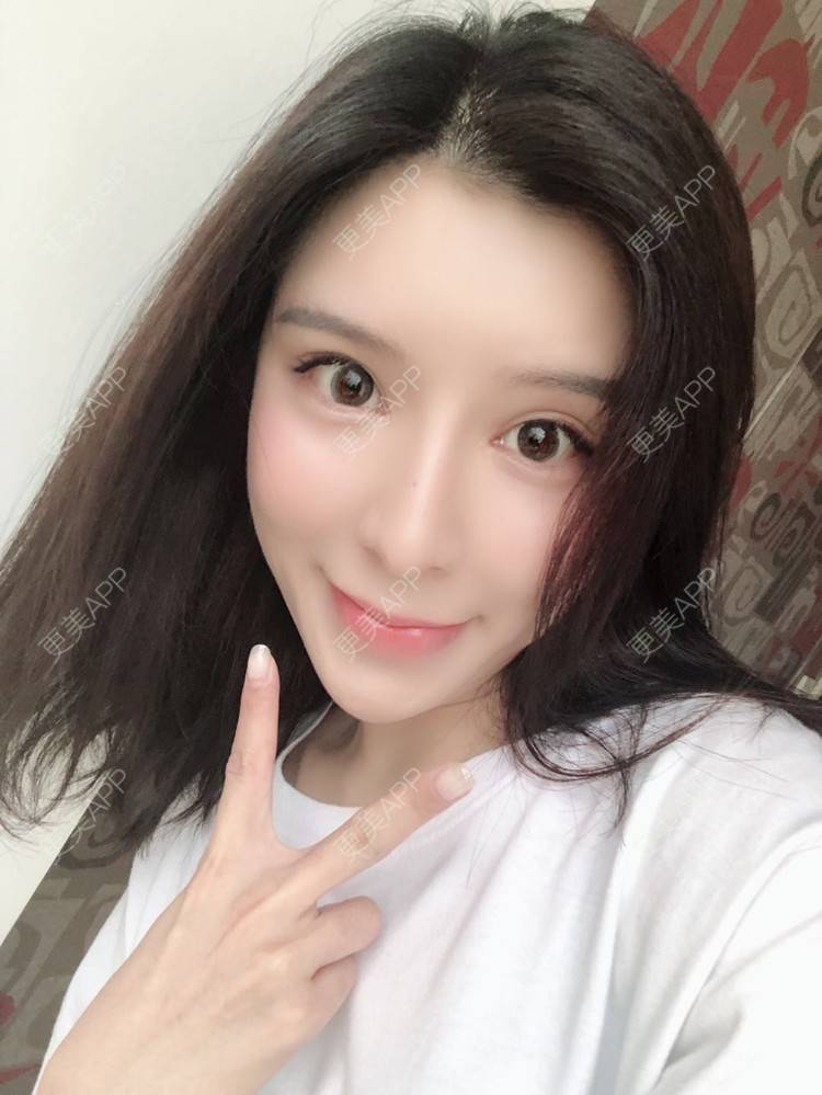 更美 - 罗莉 医生的鼻部多项经验 | 福州 | 隆鼻 | 鼻部多项 | 鼻部综合