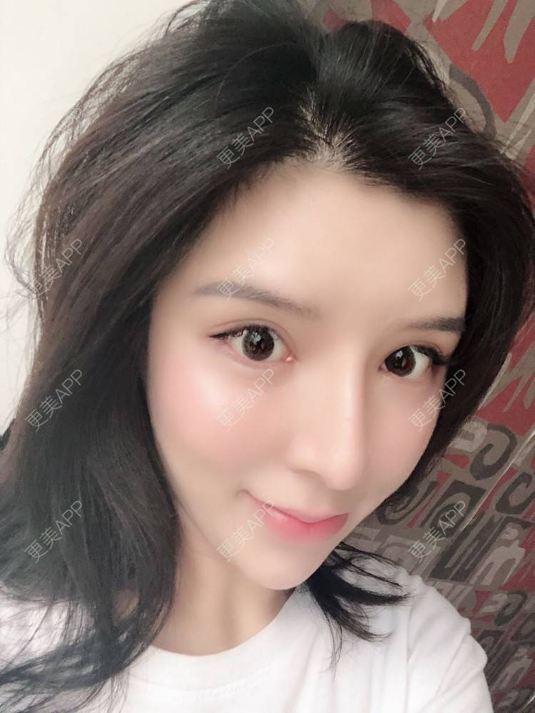 更美 - 罗莉 医生的鼻部多项经验 | 福州 | 隆鼻 | 鼻部多项 | 鼻部综合