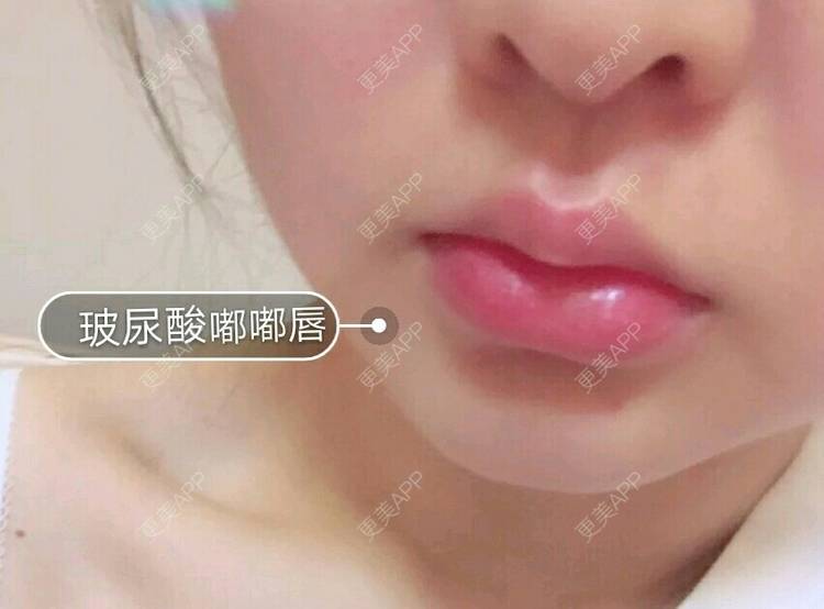 更美 - 更美用户autZA3zylV的玻尿酸唇部经验 | 玻尿酸唇部 | 成都